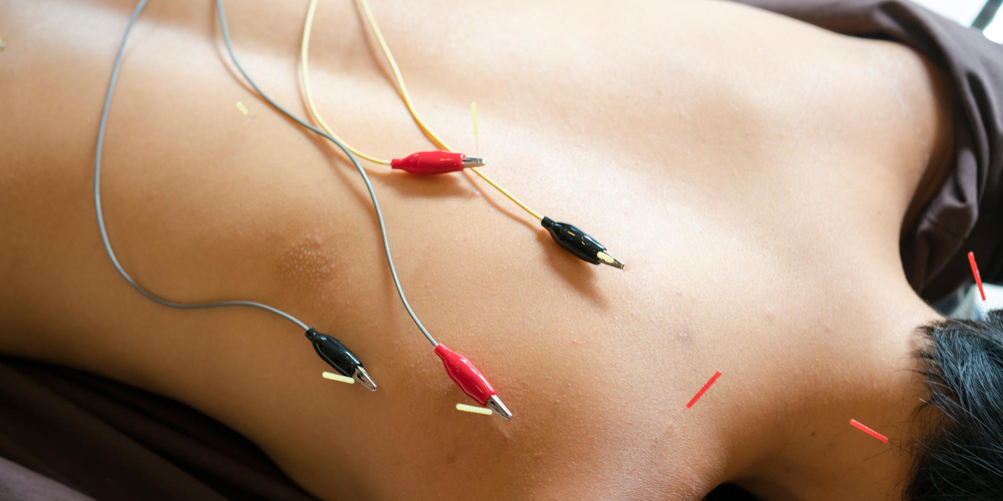 E-Stim - LK Acupuncture : LK Acupuncture